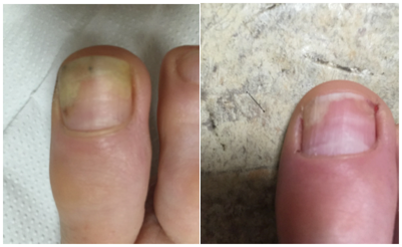 Onychomycosis: What Is It & How to Treat It