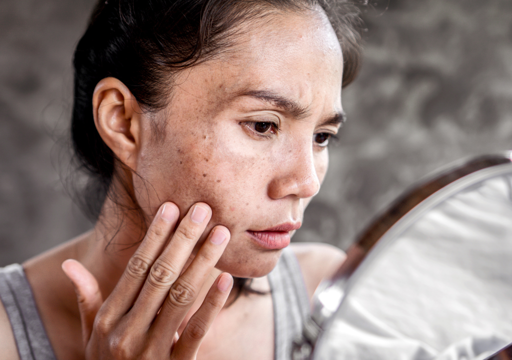 Woman looking at hyperpigmentation in the mirror