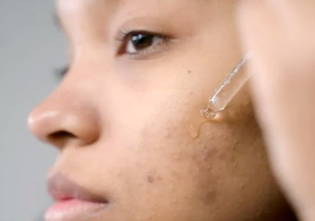 Melasma Treatment: The Best Ingredients and Skincare Routine