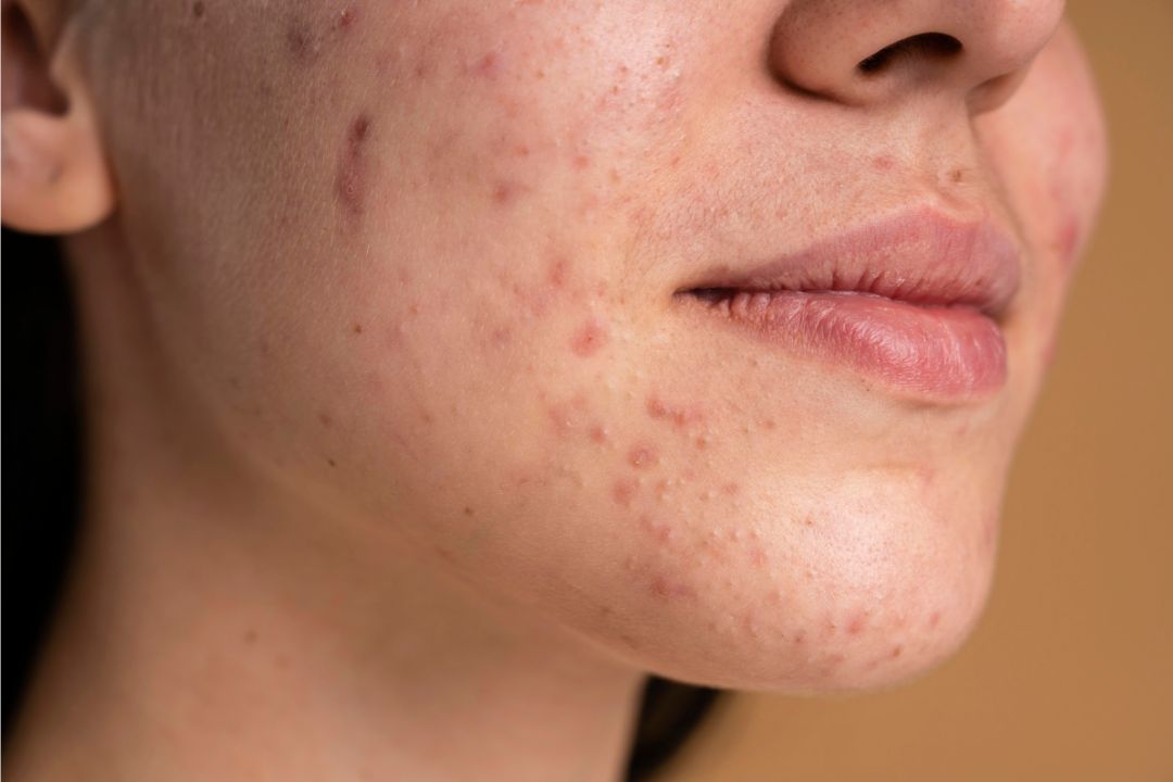 What is Acne? Understanding Your Skin Is The First Step To Treating Your Acne
