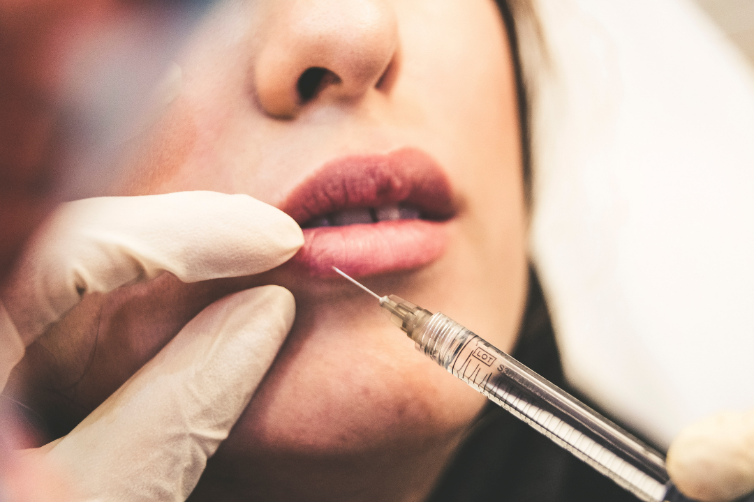 What To Consider Before Having Juvederm Dermal Filler