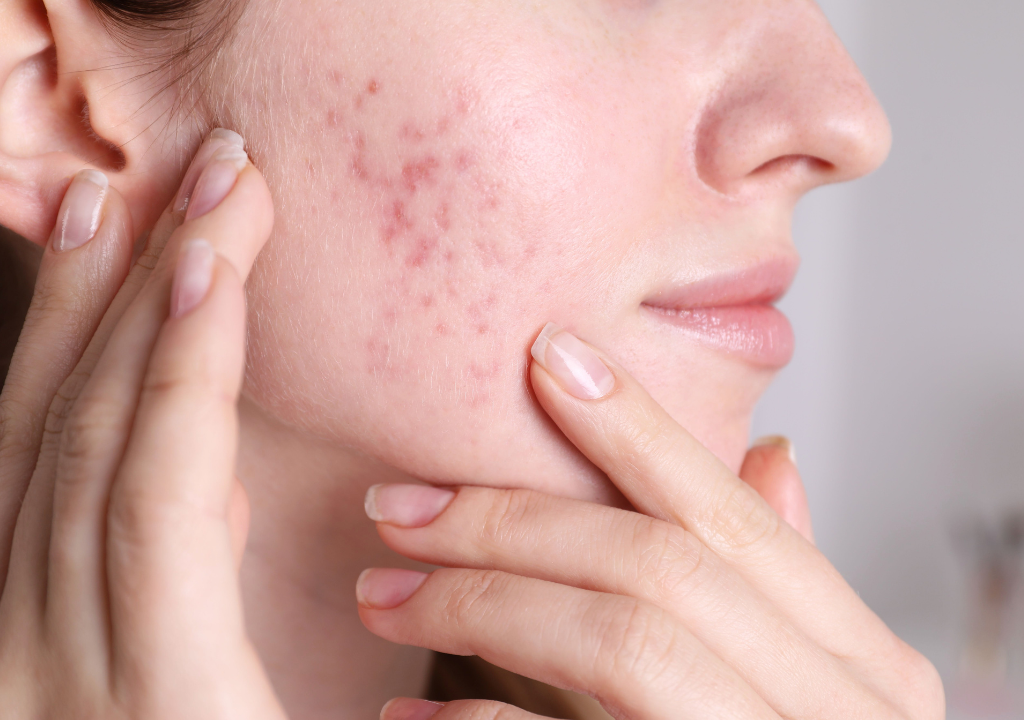 Adult Acne: Honest Advice for Clearer, Calmer Skin