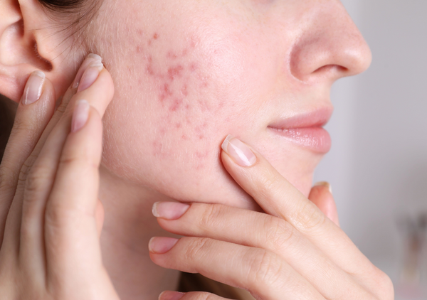 Adult Acne: Honest Advice for Clearer, Calmer Skin