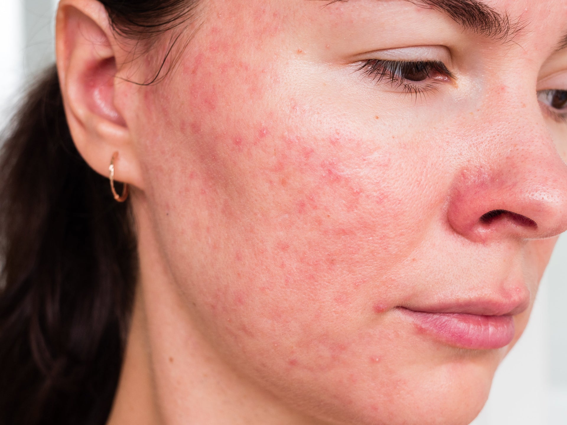 Why Am I Getting Acne on My Cheeks? Causes, Triggers and Treatments