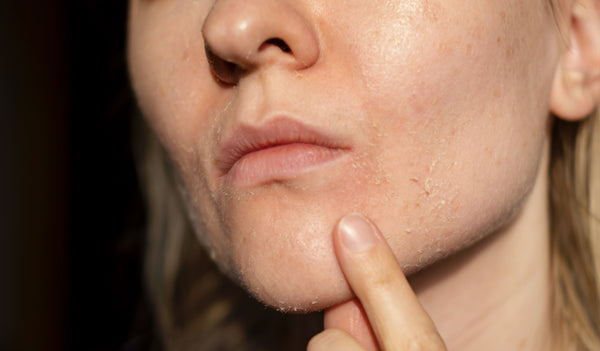 damaged skin barrier