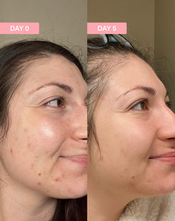 Before and after using the product for 5 days showing a more youthful skin