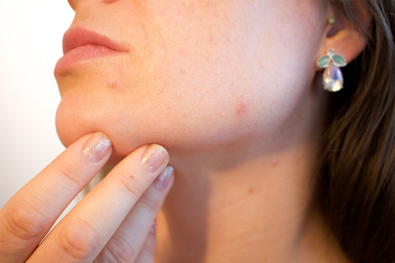 10 Spot Treatments To Banish Your Blemishes