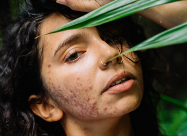 How To Know What Type Of Acne You Have