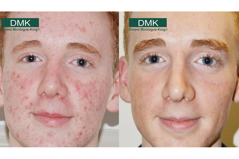 Men's Skincare Week: Male Acne