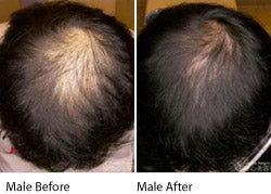 Hair Loss / Thinning hair and eDS Dermastamp