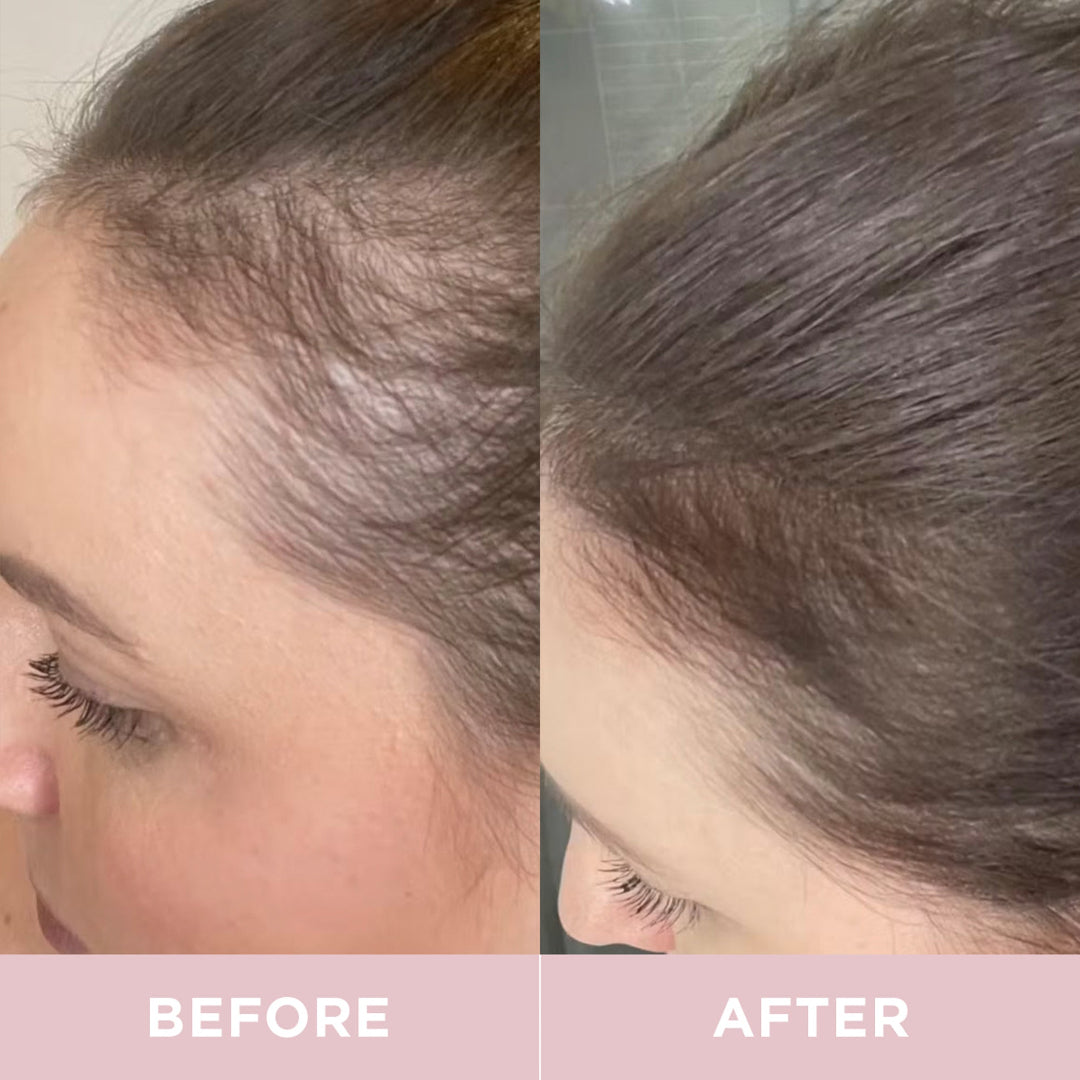 Before and after comparison of hair growth on a person's head.