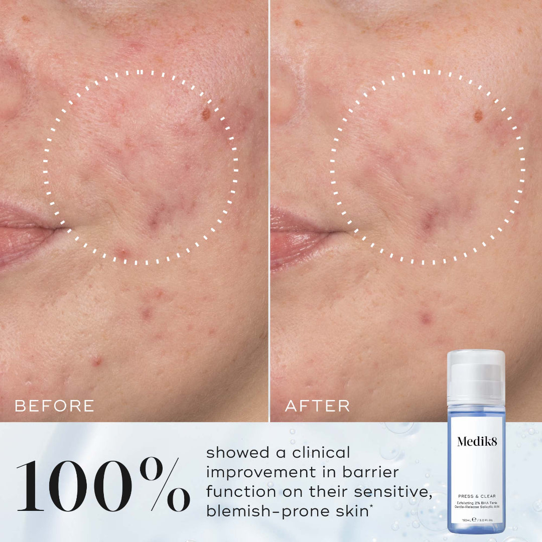 Before and after comparison of skin with blemishes, showing a clinical improvement with Medik8 product.