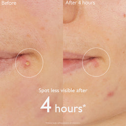 Caudalie Vinopure Salicylic Spot Solution 15ml