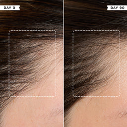 Before and after comparison of hair growth on a scalp, showing a significant increase over 90 days.