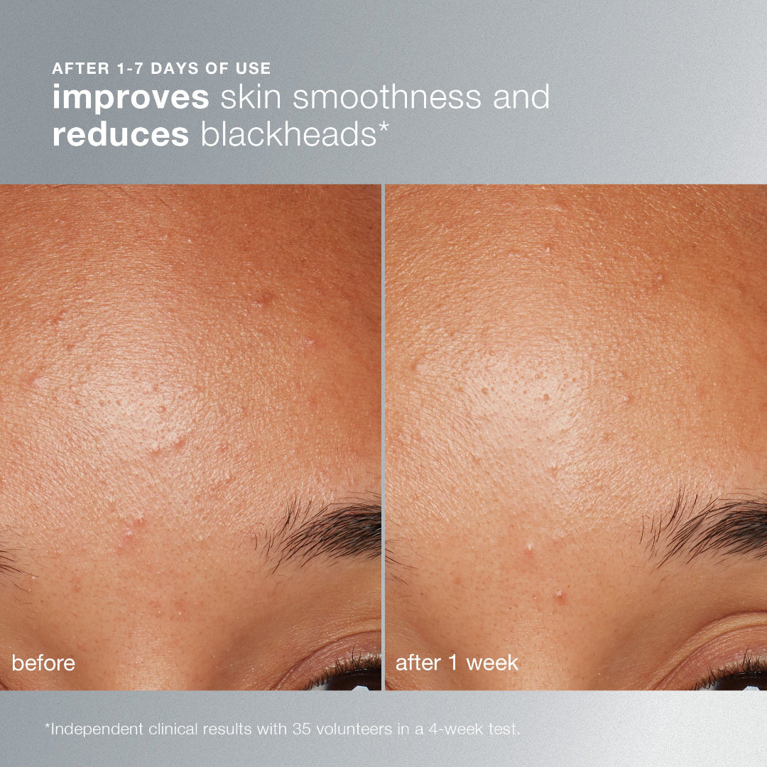 Before and after skin comparison showing improvements in smoothness and reduction of blackheads.