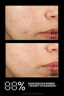 Before and after comparison of acne treatment on a person's face with text indicating improvement over 56 days.