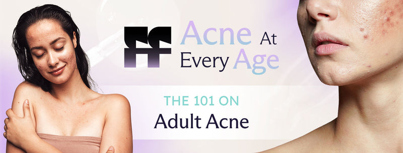 adult acne
