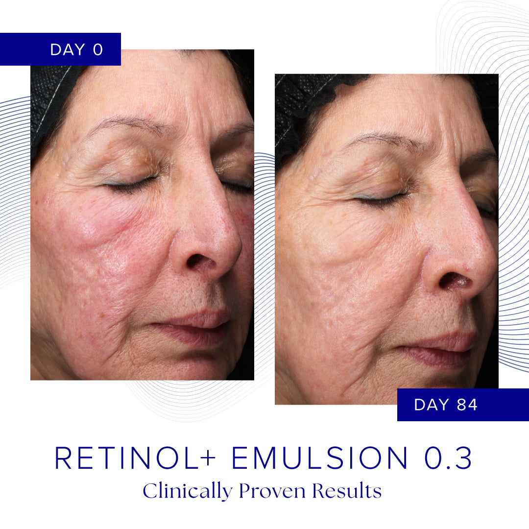Before and after comparison of a woman's face using Retinol Emulsion 0.3, showing clinical proven results.