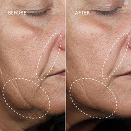 Close-up before-and-after comparison of a person's lower face, showing skin texture and wrinkles around the nose, mouth, and jawline. The left side is labeled BEFORE and shows more visible wrinkles, while the right side is labeled AFTER and appears smoother.