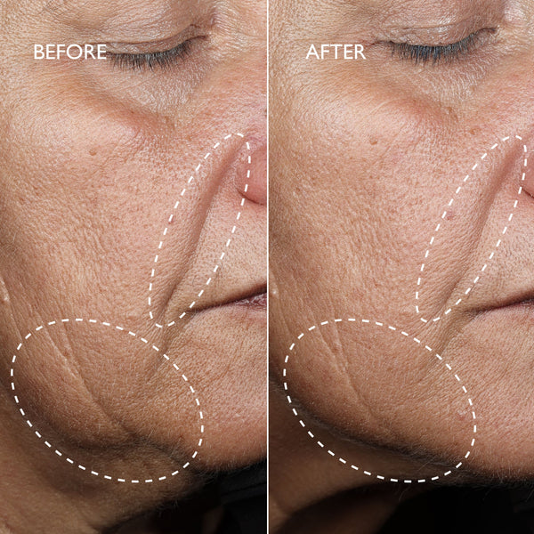 Close-up before-and-after comparison of a person's lower face, showing skin texture and wrinkles around the nose, mouth, and jawline. The left side is labeled BEFORE and shows more visible wrinkles, while the right side is labeled AFTER and appears smoother.
