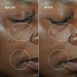 Close-up before-and-after comparison of a person's cheek and mouth area, with white dashed circles highlighting skin texture and wrinkles. The left side is labeled BEFORE and shows more visible lines, while the right side is labeled AFTER and appears smoother.