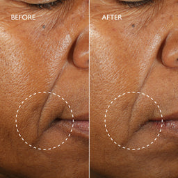 Close-up before-and-after comparison of a person's lower face, showing skin texture and a fold around the mouth. The left side is labeled BEFORE with a dashed circle highlighting the fold, and the right side is labeled AFTER with the same circle over the treated area.