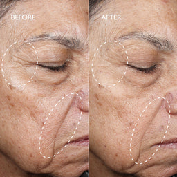 A side-by-side before and after close-up of an older woman's lower face, showing wrinkles around the eye and cheek with white dashed circles highlighting areas of improvement. The left panel is labeled BEFORE and the right panel is labeled AFTER.