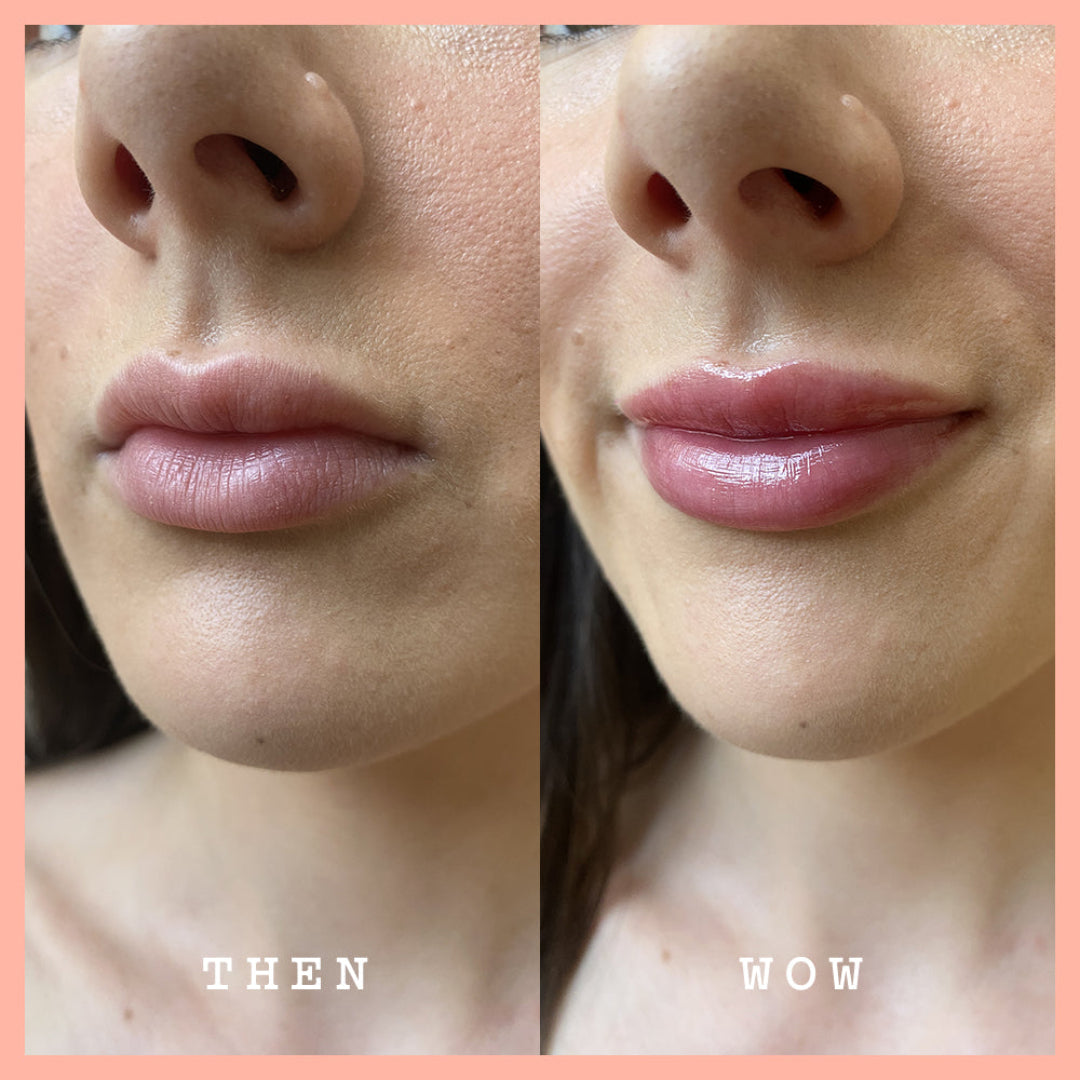 Before and after comparison of a woman's lips with 'Then' and 'Wow' labels.