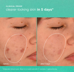 Dermalogica Breakout Biotic Moisturiser 50ml