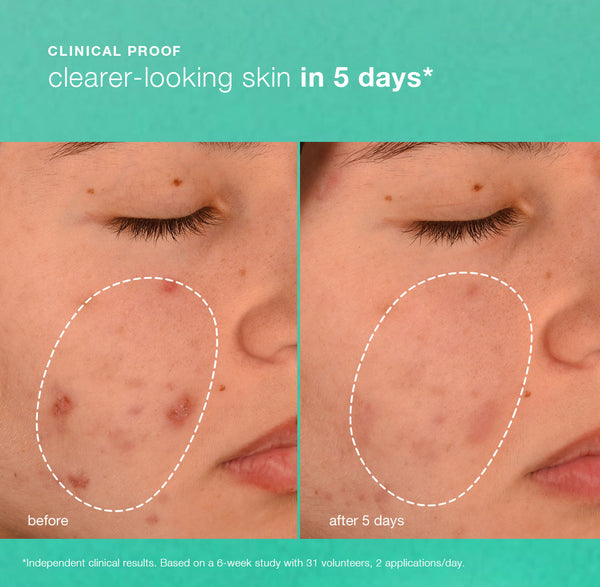 Dermalogica Breakout Biotic Moisturiser 50ml