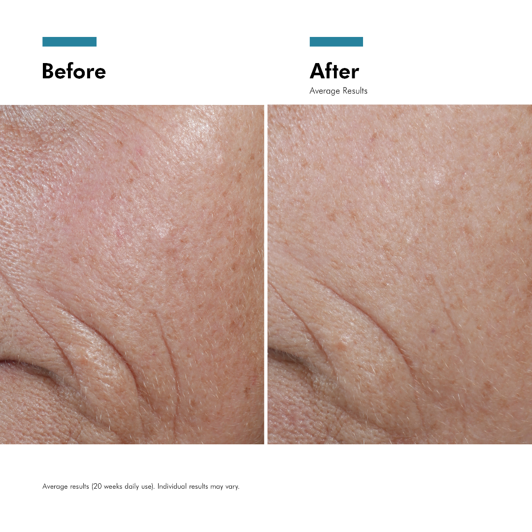 Before and after comparison of skin texture with visible improvement.