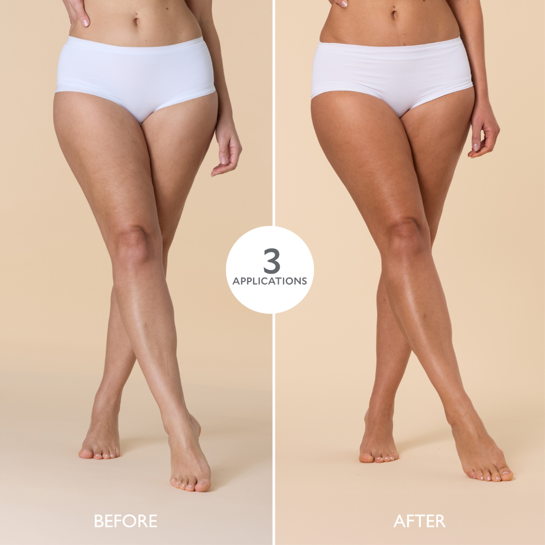 Before and after comparison of legs with three applications on a beige background