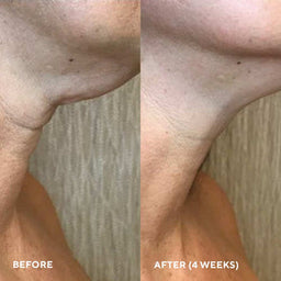 HydroPeptide FIRM.A.FIX Nectar Lifting Neck and Decollete Serum before and after