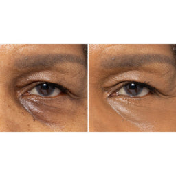 A side-by-side close-up comparison of a person's under-eye area, showing a before-and-after style view of dark circles and skin tone.