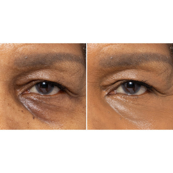 A side-by-side close-up comparison of a person's under-eye area, showing a before-and-after style view of dark circles and skin tone.