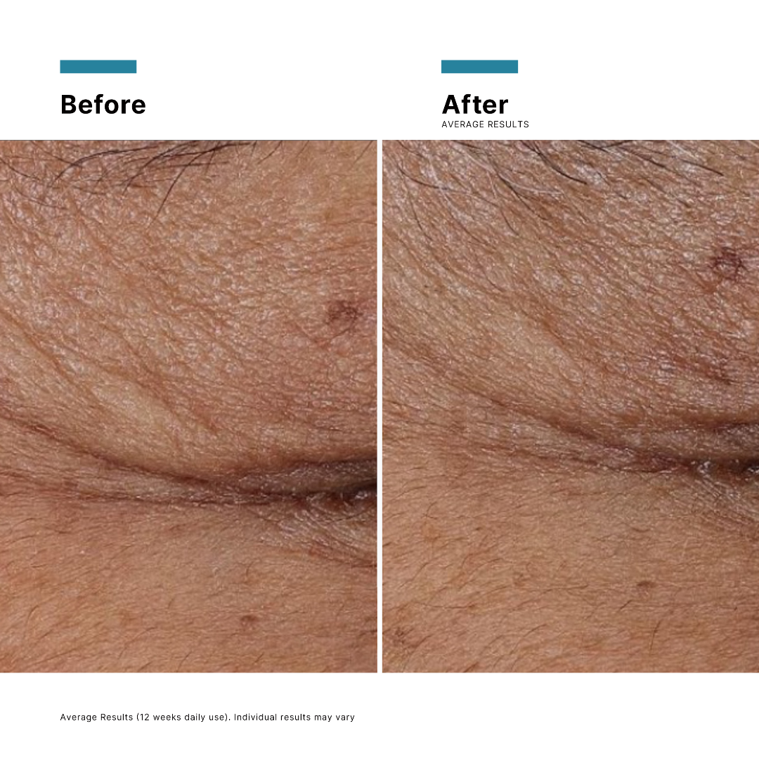 Before and after comparison of skin texture on a white background