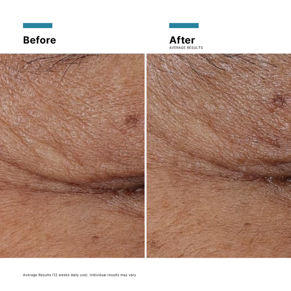 Before and after comparison of skin texture on a white background