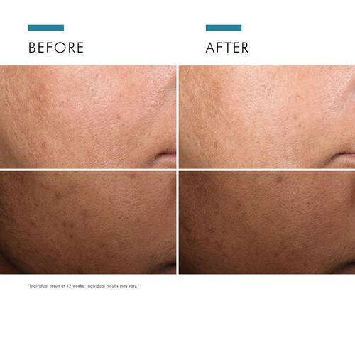 before and after