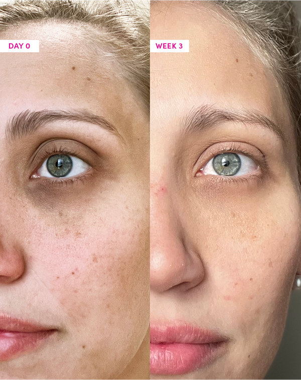 Before and after use of Sand & Sky Anti-Ageing Eye Cream after 3 weeks