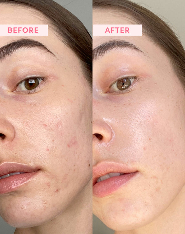 Before and after using the product showing a greater improvement of pores