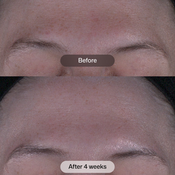 Before-and-after comparison of a person's forehead showing skin improvement after 4 weeks, with a 'Before' label on the top panel and 'After 4 weeks' on the bottom panel.