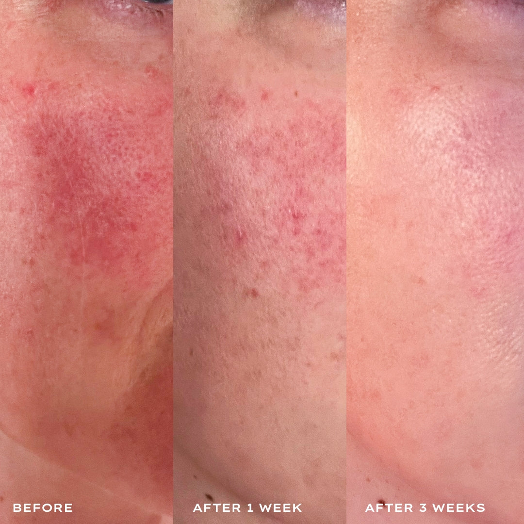 Before and after comparison of skin treatment on a person's face over three weeks.