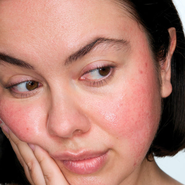 Close-up of a woman's face with visible skin concerns