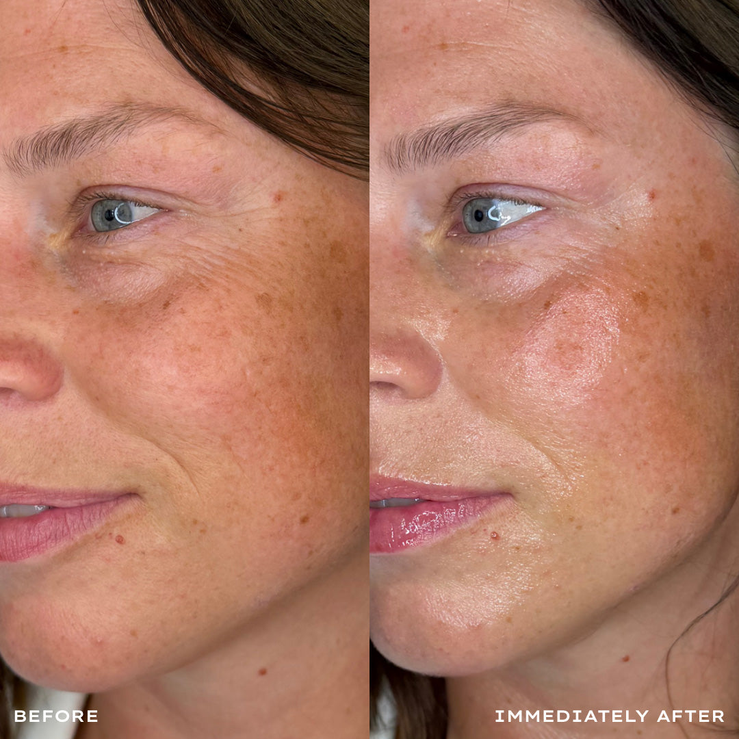 Close-up before-and-after side-by-side comparison of a woman's cheek and eye area, showing skin texture and freckles. The left side is labeled 'BEFORE' and the right side is labeled 'IMMEDIATELY AFTER'.