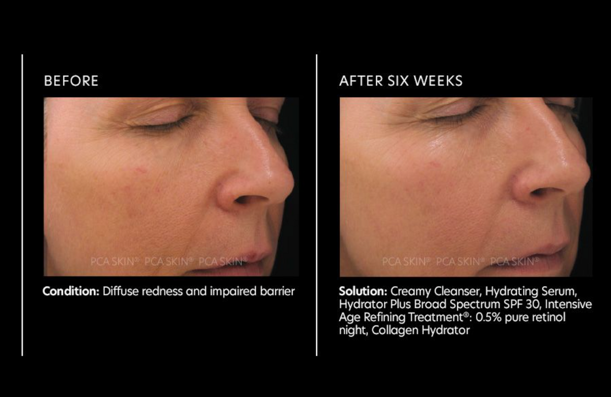 PCA Skin Intensive Age Refining Treatment 0.5% Pure Retinol Night 1oz