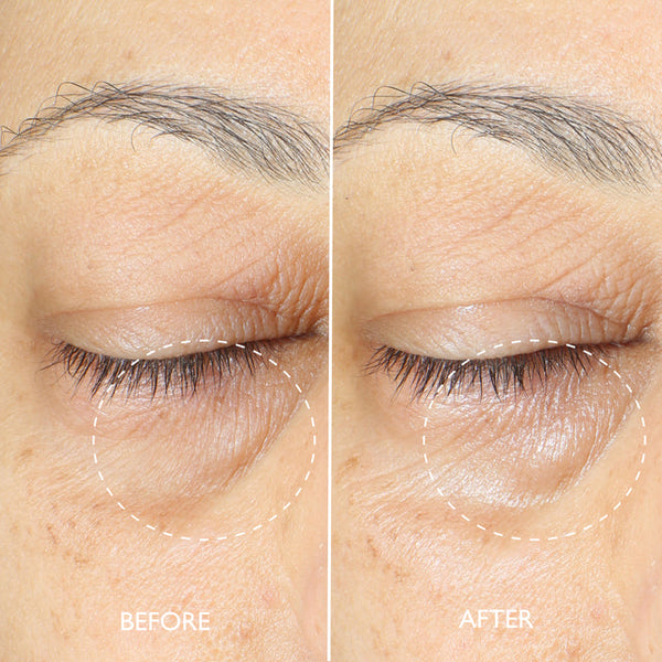 Before and after comparison of eye area skin texture on a person's face.