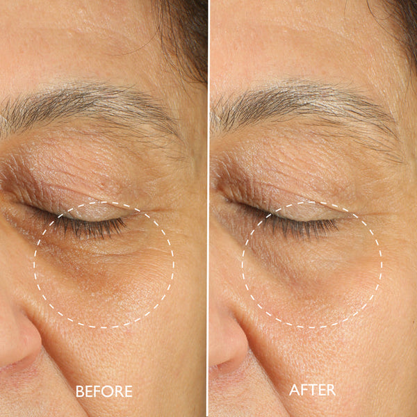 Before and after comparison of eye area on a person's face