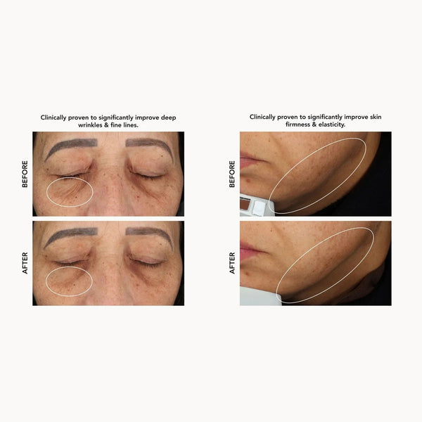 Before-and-after comparison collage showing facial wrinkles and fine lines improvement on a light gray background. The left panel shows closed eyes with text about deep wrinkles and fine lines; the right panel shows a close-up cheek/jaw area with text about skin firmness and elasticity.