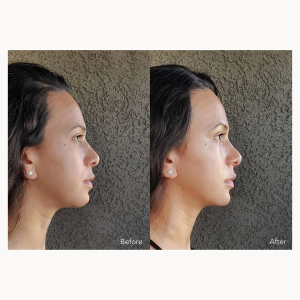 Before and after side profile comparison of a woman's face, showing a cosmetic or dental treatment result, set against a textured gray wall.
