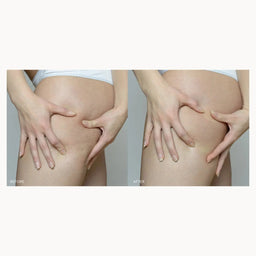 A side-by-side before and after comparison showing a person's hip and upper thigh area, with the left side displaying more visible skin folds and the right side appearing smoother and tighter.